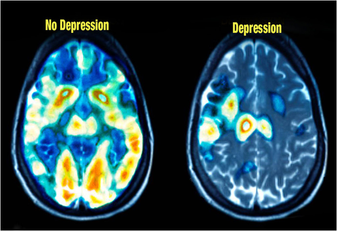 The Depressed Brain vs Normal Brain